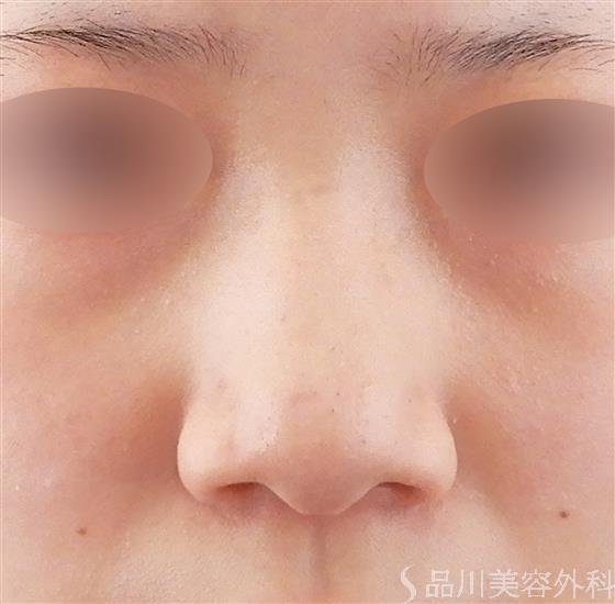 症例NO.61876のBEFORE写真