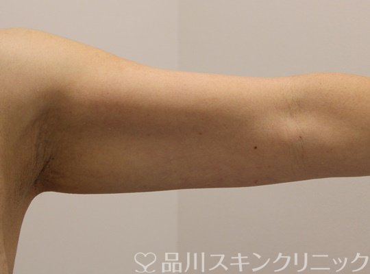 症例NO.72154のAFTER写真