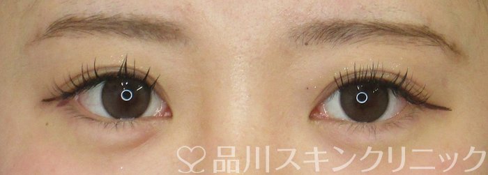 症例NO.64887のAFTER写真