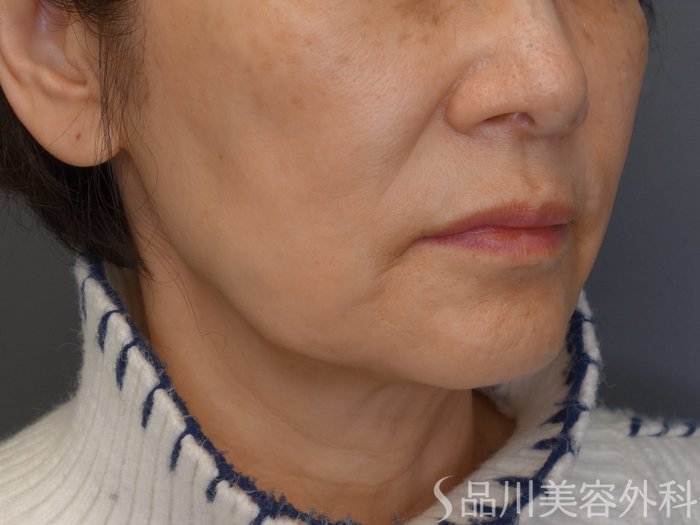 症例NO.69359のBEFORE写真