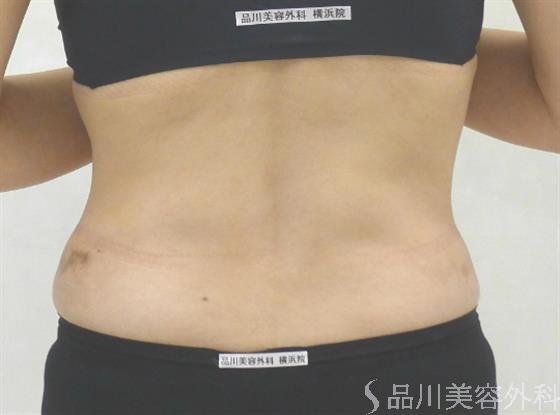症例NO.43172のAFTER写真