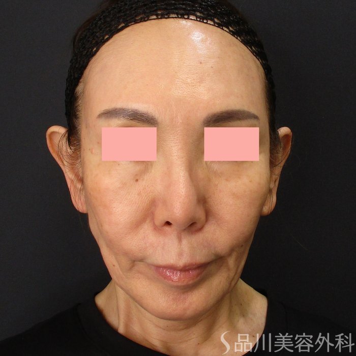 症例NO.72113のBEFORE写真