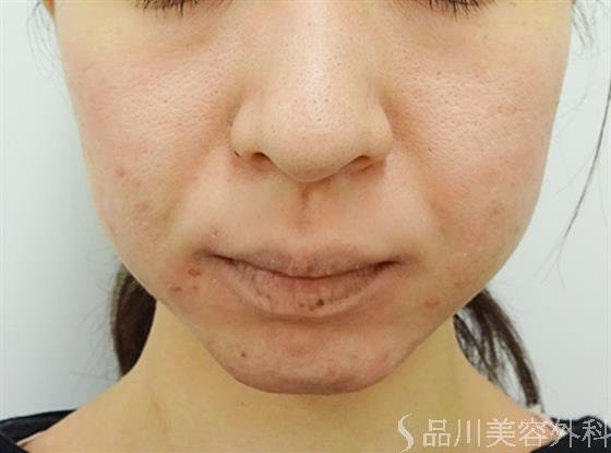 症例NO.40748のAFTER写真