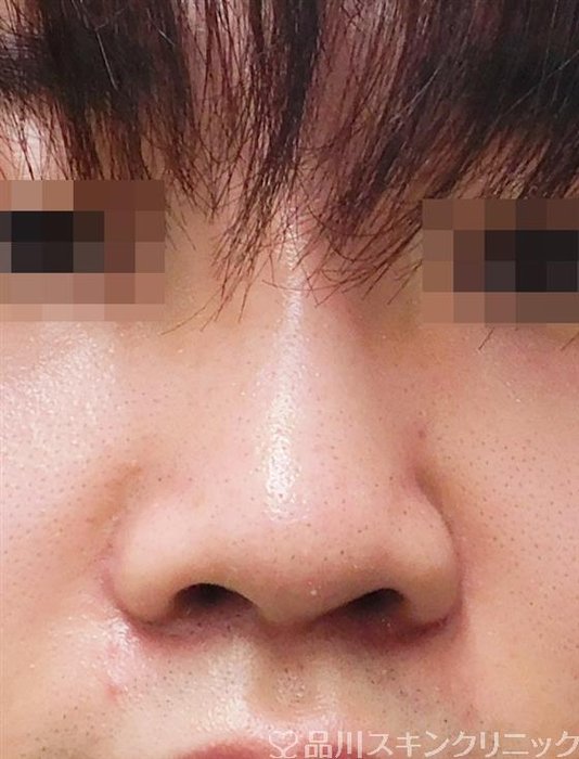 症例NO.55569のAFTER写真