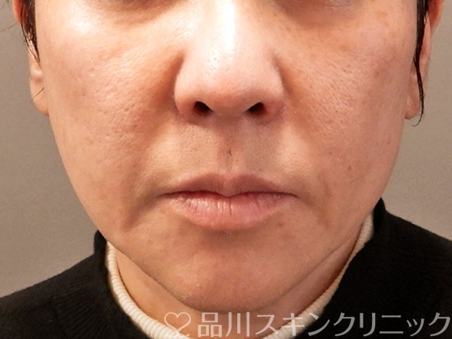 症例NO.69756のBEFORE写真