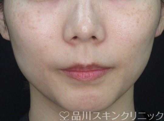 症例NO.70711のAFTER写真