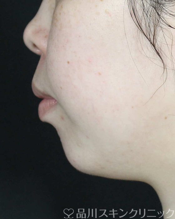 症例NO.70587のBEFORE写真
