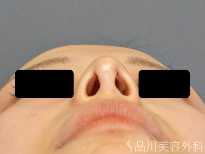 症例NO.74055のAFTER写真