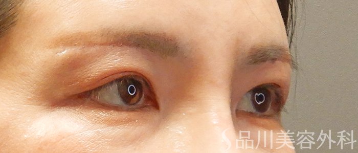 症例NO.69424のAFTER写真