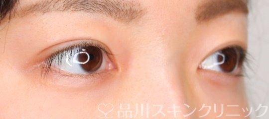 症例NO.70591のAFTER写真