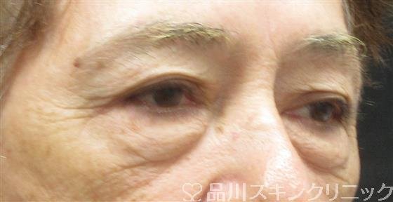 症例NO.61365のBEFORE写真