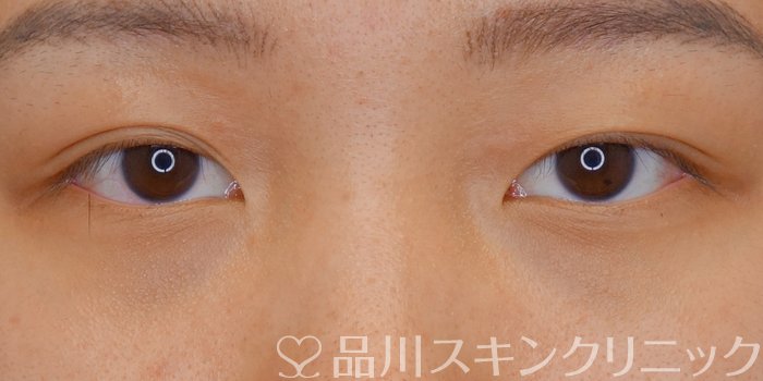 症例NO.72572のBEFORE写真