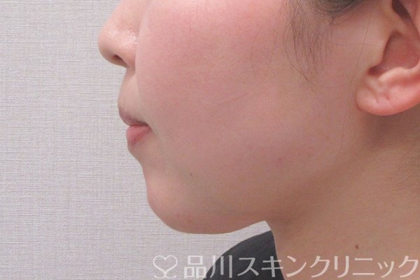 症例NO.74576のAFTER写真