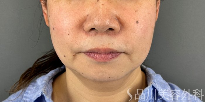 症例NO.70812のBEFORE写真