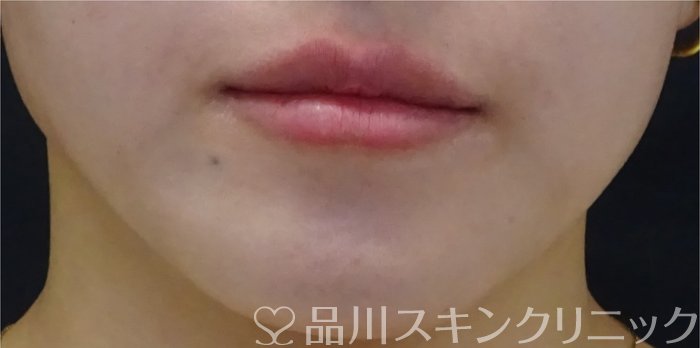 症例NO.69325のAFTER写真