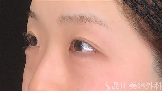 症例NO.60979のBEFORE写真