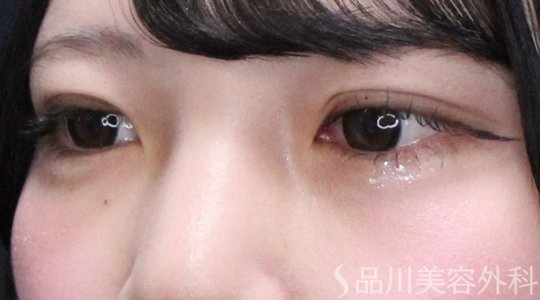 症例NO.73617のAFTER写真