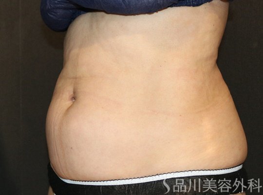 症例NO.73513のAFTER写真