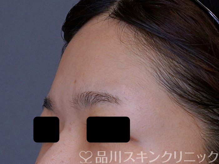 症例NO.74711のBEFORE写真
