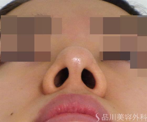 症例NO.47081のBEFORE写真