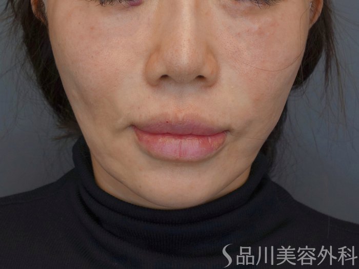 症例NO.74194のAFTER写真