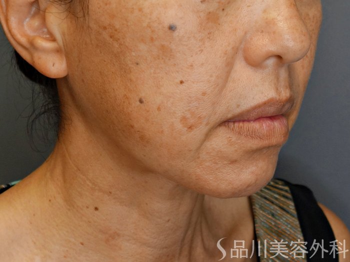 症例NO.71573のBEFORE写真