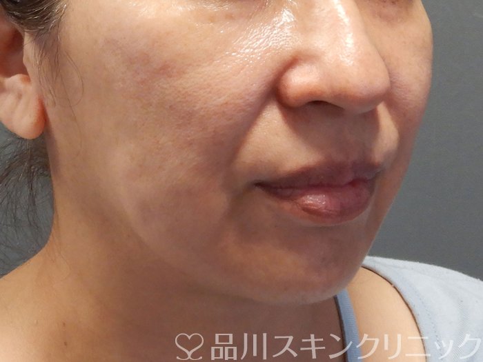 症例NO.70602のBEFORE写真