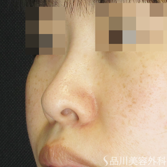 症例NO.70243のBEFORE写真