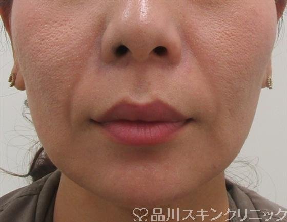 症例NO.40024のBEFORE写真