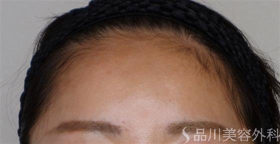 症例NO.48425のAFTER写真