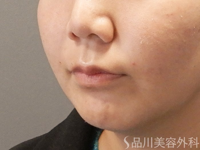 症例NO.67988のAFTER写真