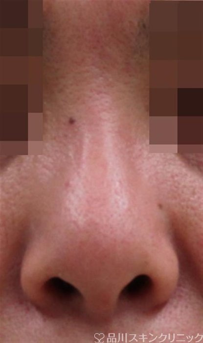 症例NO.34505のBEFORE写真