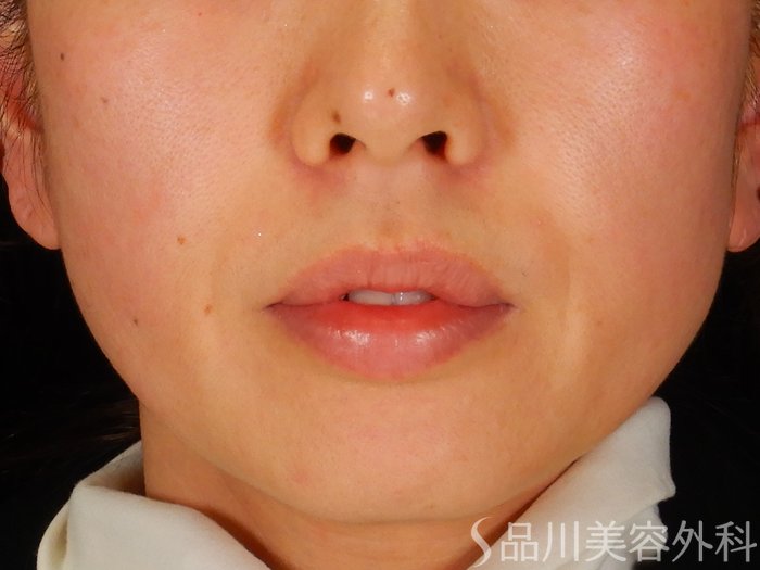 症例NO.67940のBEFORE写真