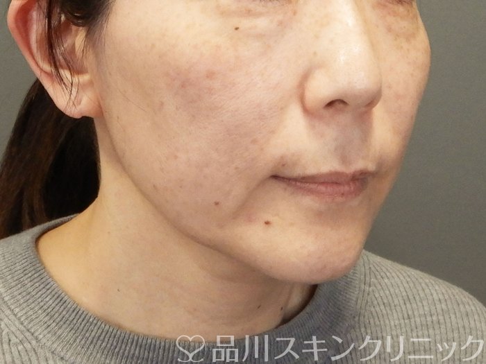 症例NO.70301のBEFORE写真