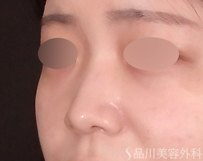 症例NO.70285のBEFORE写真