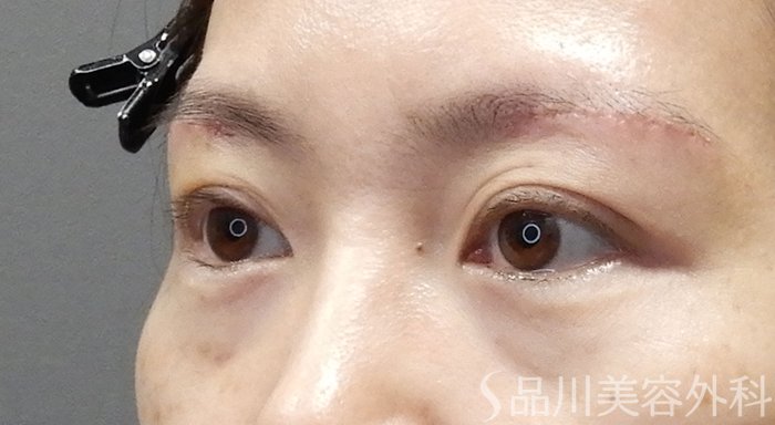 症例NO.70688のAFTER写真