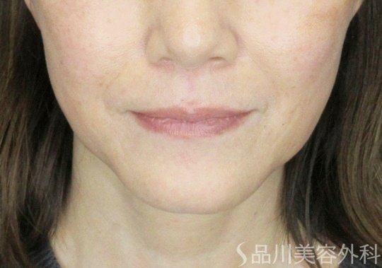 症例NO.71255のBEFORE写真