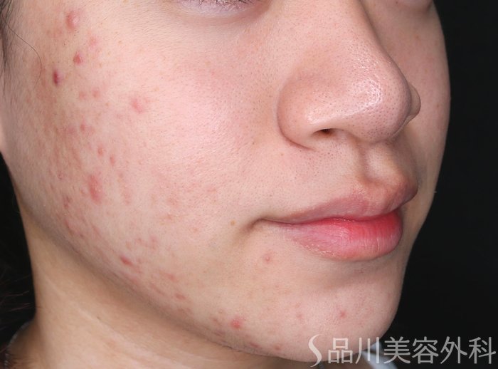 症例NO.72569のBEFORE写真