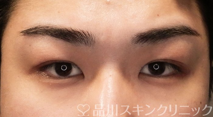 症例NO.69613のBEFORE写真