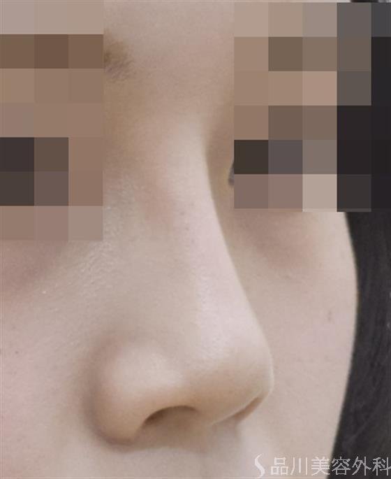 症例NO.47631のAFTER写真