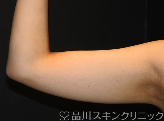 症例NO.70215のAFTER写真