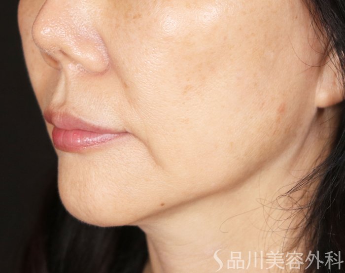 症例NO.71593のBEFORE写真