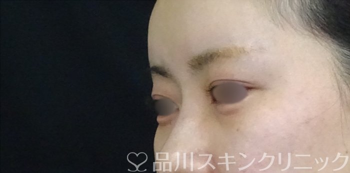 症例NO.70892のAFTER写真