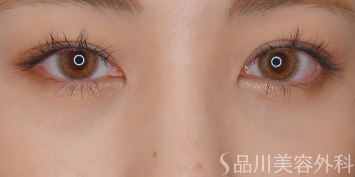 症例NO.70149のAFTER写真