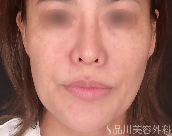 症例NO.69811のBEFORE写真