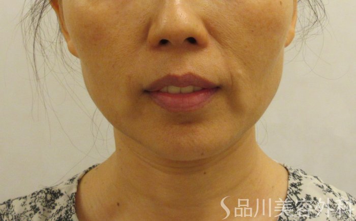 症例NO.71578のBEFORE写真