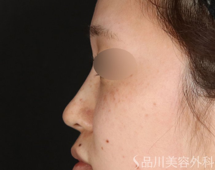 症例NO.72686のAFTER写真