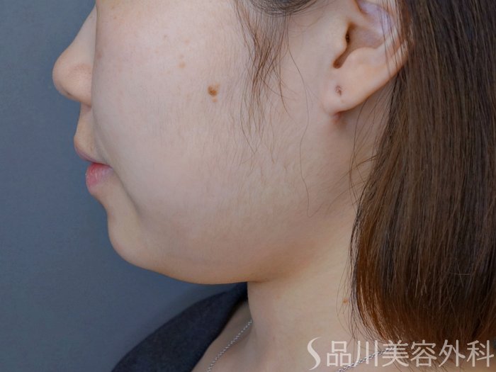 症例NO.73909のBEFORE写真