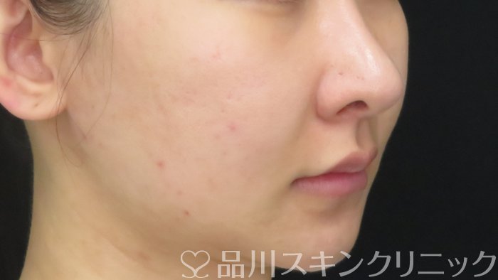 症例NO.71930のBEFORE写真