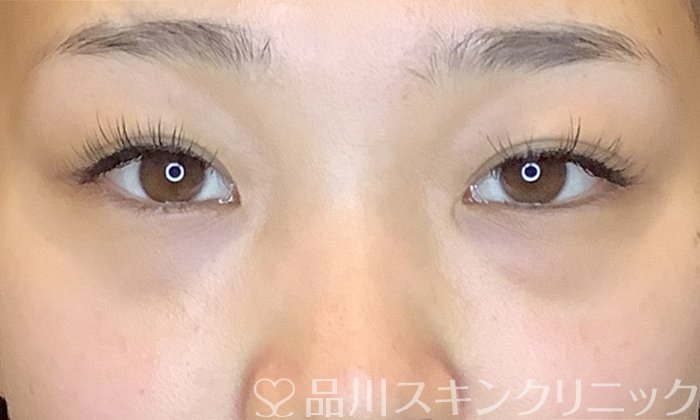 症例NO.70386のBEFORE写真